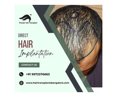 DHT Hair Transplant Bangalore | DHI Hair Transplant Cost - Image 3