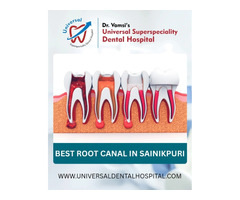 Expert Root Canal Treatment at Universal Dental Hospital – Save Your Natural Tooth!