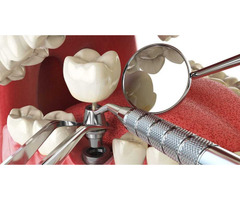 Dental Clinic | Dentist | Bangalore | Indiranagar | Best Dental Care - Image 3