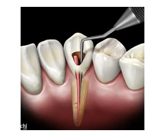 Dental Clinic | Dentist | Bangalore | Indiranagar | Best Dental Care - Image 4