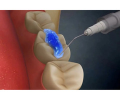 Dental Clinic | Bangalore | Best Dental Care | Discover Your Smile - Image 3