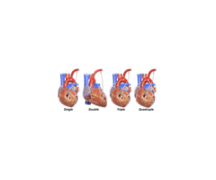 MIDCAB Surgery Bangalore | Minimally Invasive Bypass