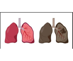 Tuberculosis Specialist in Jaipur, Rajasthan | Expert TB Treatment