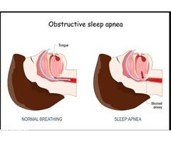 Best Sleep Apnea Doctor in Jaipur, Rajasthan – Dr. Virendra Singh