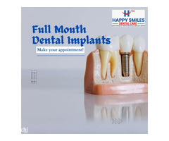 Full Month Dental Implants – Your Complete Guide to a Permanent Smile