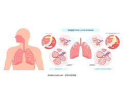 Specialized Pulmonary Fibrosis Evaluation and Respiratory Care in Jaipur, Rajasthan | Asthma Bhawan