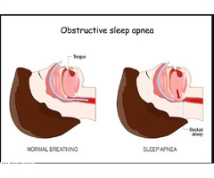 Obstructive Sleep Apnea Specialist in Jaipur for Nighttime Breathing | Dr. Virendra Singh
