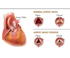 Trusted Heart Specialist for Cardiovascular Disease Care in Jaipur, Rajasthan | Dr. Ravinder Singh R