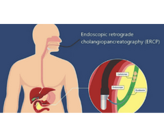 Esophageal Motility Treatment in Delhi | Expert Care