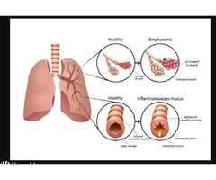 Trusted Asthma Consultation and Respiratory Care in Jaipur, Rajasthan | Asthma Bhawan