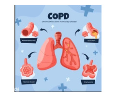 Consult an Experienced COPD Physician in Jaipur, Rajasthan – Dr. Sheetu Singh