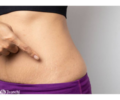 Stretch Mark Removal Clinic in Hyderabad | Stretch Marks Treatment