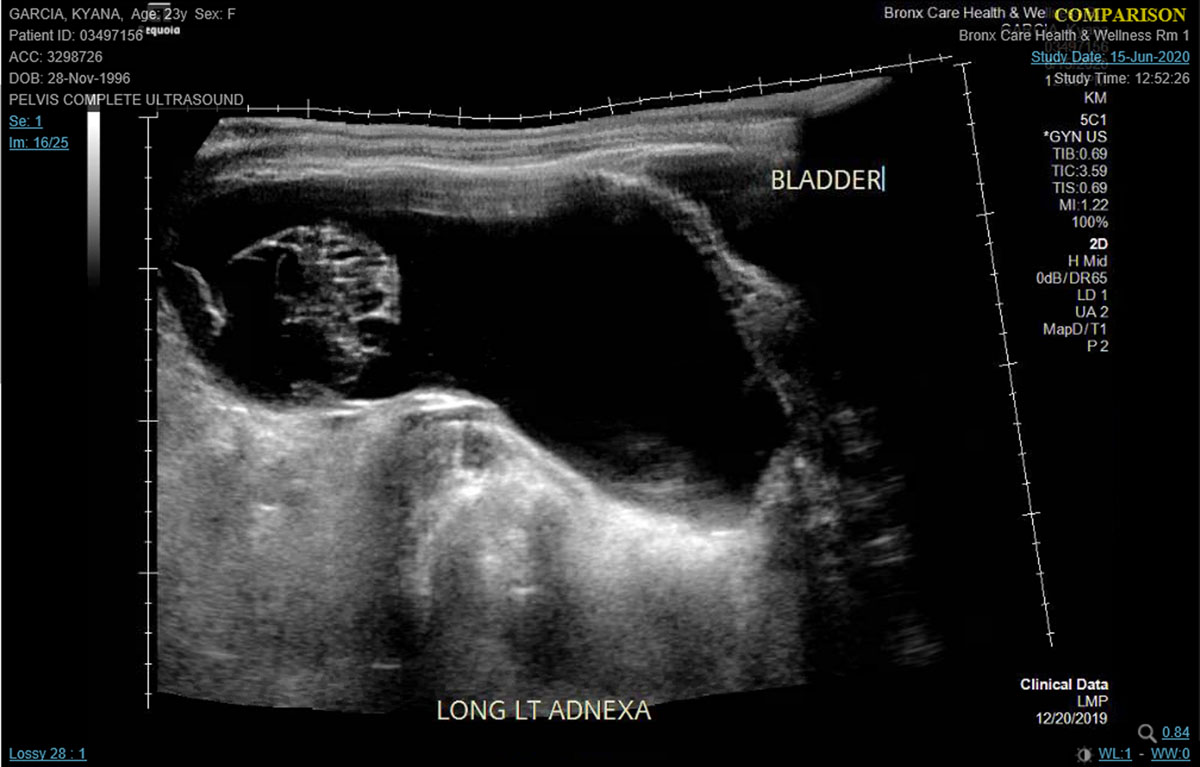 Ovarian Cysts During Pregnancy 