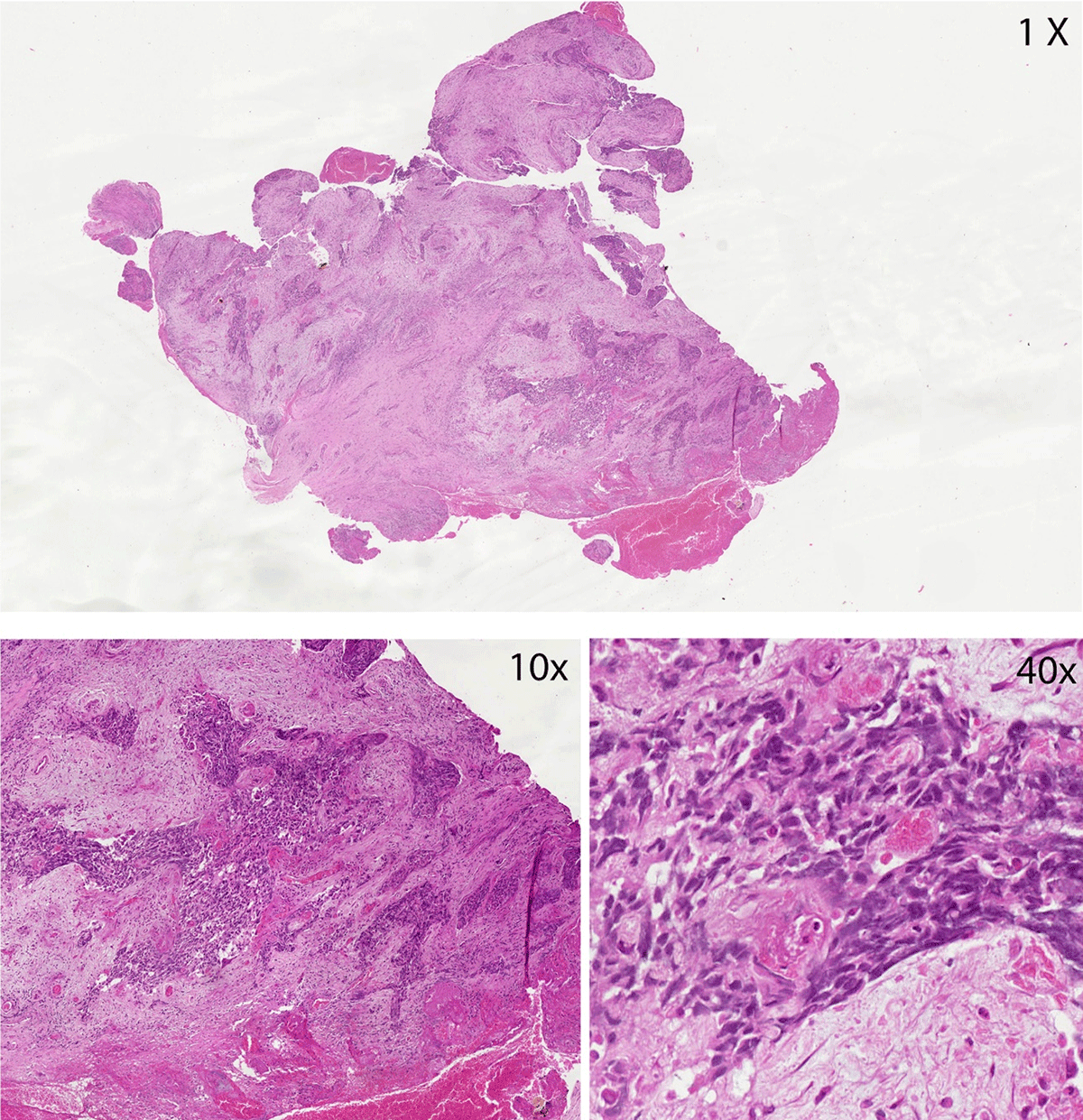 Cervical tissues with cancerous transformation