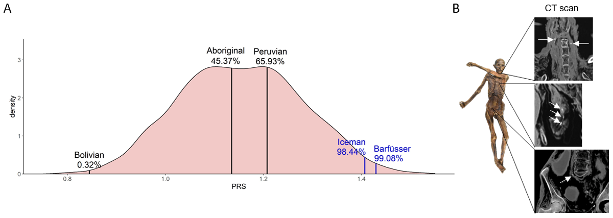 Comparison of PRSs of modern and ancient individuals. (A) Density curve of PRSs of 2504 unrelated modern individuals from 26 populations from all over the world. PRSs of ancient individuals are plotted on top of the modern individuals. The percentage displays the number of modern individuals with a lower PRS than the ancient individual. In blue: Individuals with calcified plaques identified on CT scans. (B) In CT scans of the Iceman calcifications were found within the carotid artery, the area of the heart, and the right iliac artery