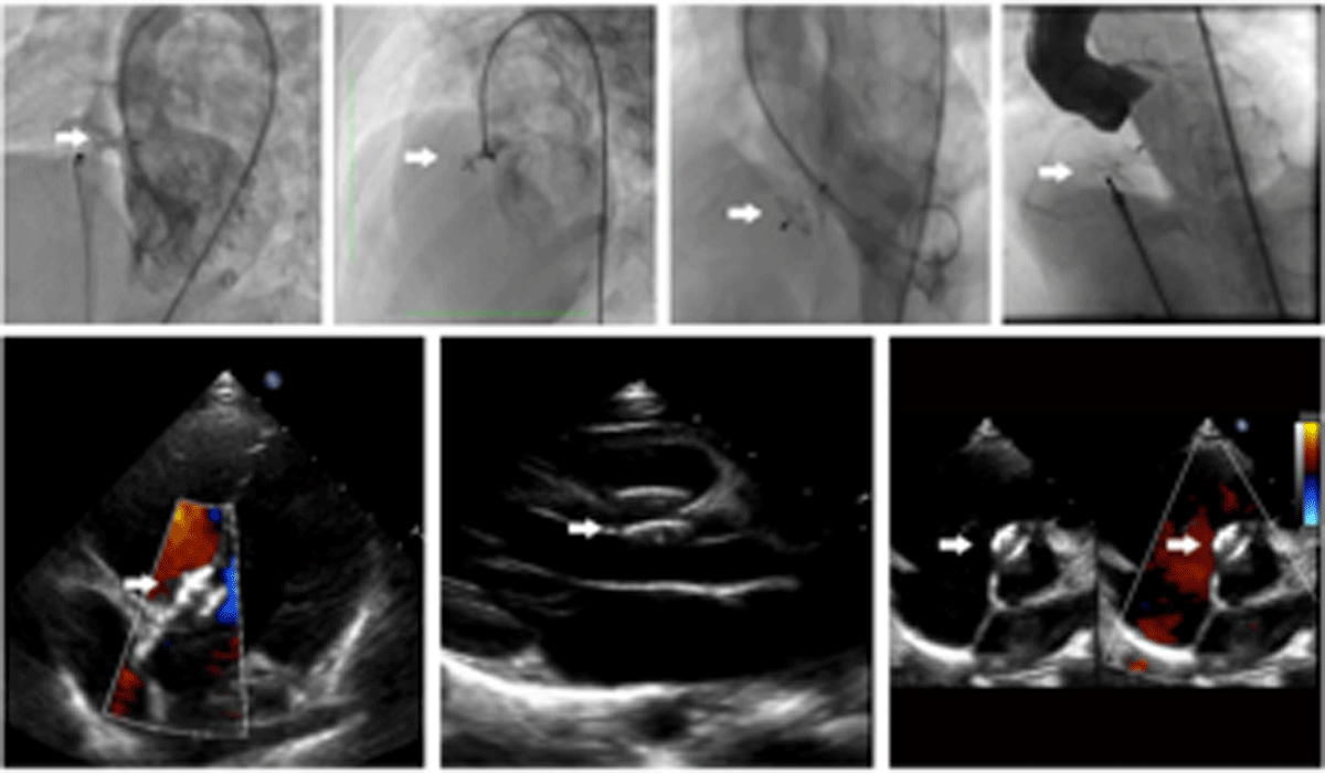 Angiography and echocardiography after closure.