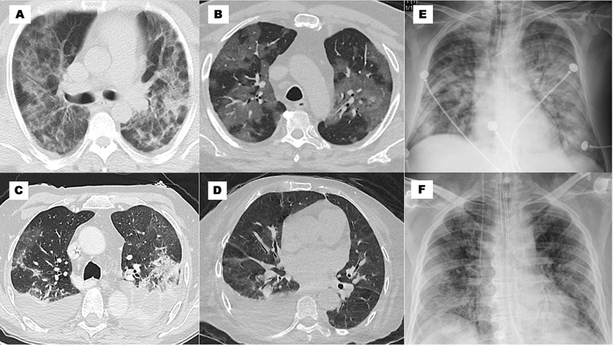 Image patterns. (A) cTC: infiltrates in ground glass >50%, crazy paving and alveolar consolidation bilateral; (B) cTC: infiltrates in ground glass >50% bilateral; (C) cTC: infiltrates in ground glass 25–50% and pleural effusion bilateral; (D) cTC: infiltrates in ground glass <25% and pleural effusion unilateral; € cX-ray: peripheral, basal, and hilar infiltrates; ground glass pattern; and consolidation; (F) cX-ray: basal and peripheral infiltrates, and ground glass pattern