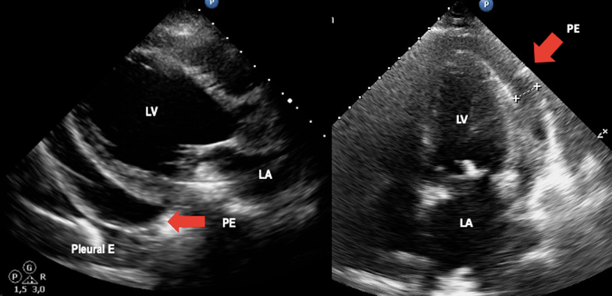 Transthoracic echocardiogram at admission and 6 mo follow up: global