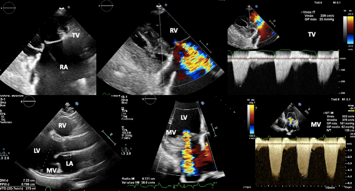 Longitudinal strain by speckle tracking and echocardiographic parameters as  predictors of adverse cardiovascular outcomes in chronic Chagas  cardiomyopathy