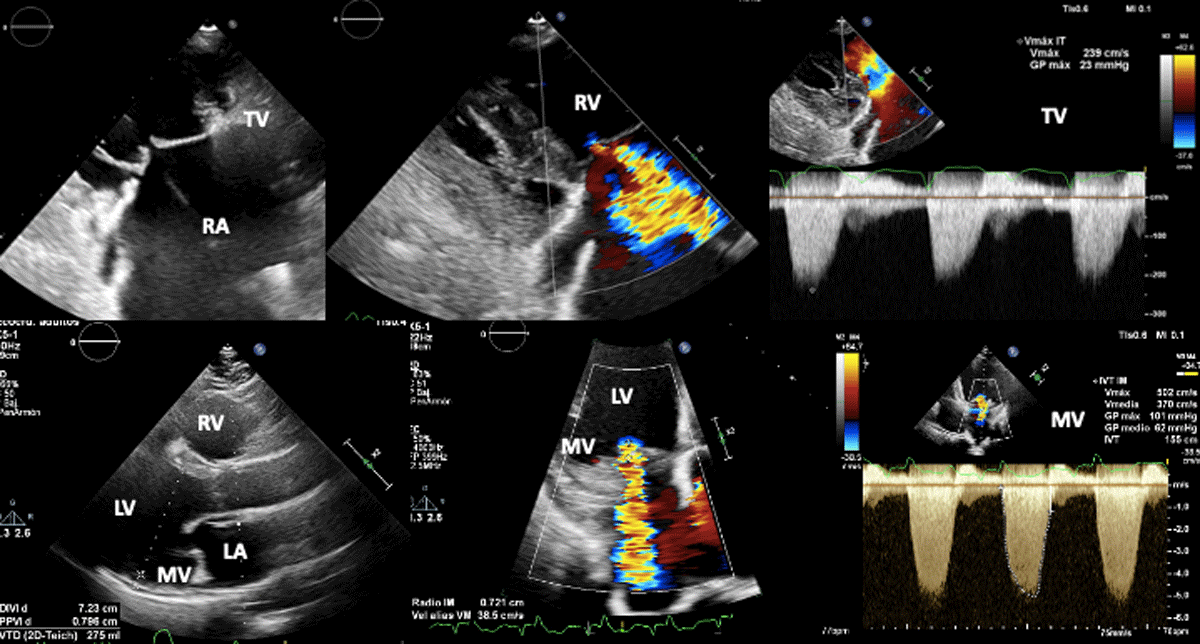 Transthoracic echocardiogram at admission and 6 mo follow up: global