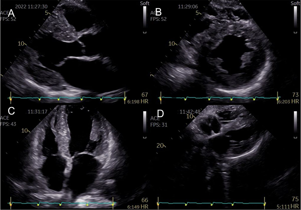 Representative two-dimensional echocardiography features of a patient with ATTR-CM