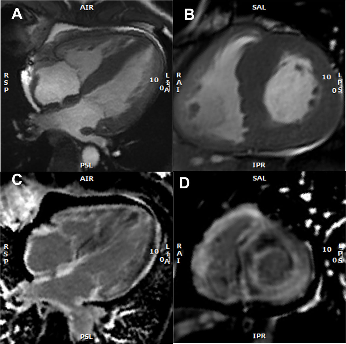 Cardiac magnetic resonance imaging with representative examples of ATTR-CM