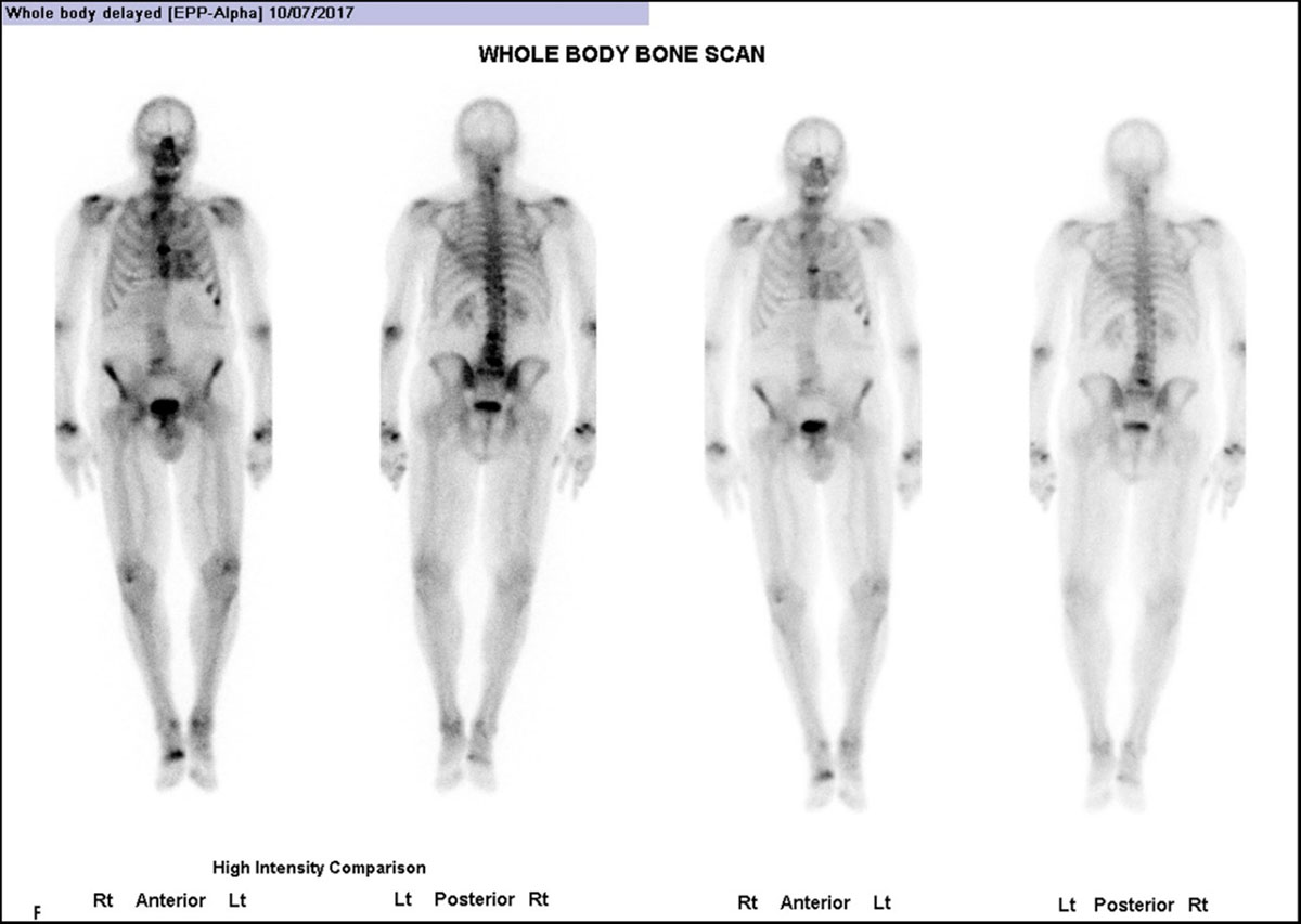 8 ATTR-CM: Whole body anterior planar view and posterior– 3 hours post-injection Tc99 m-DPD