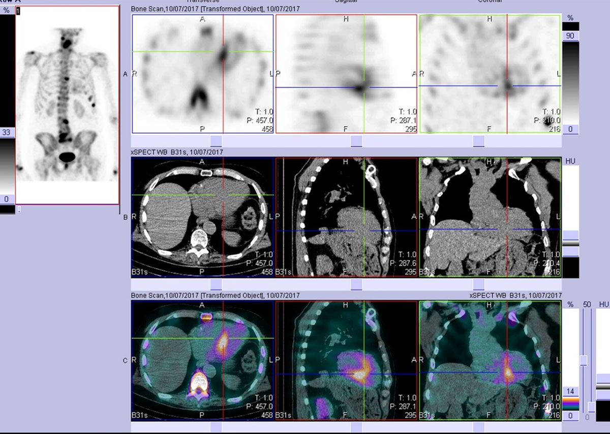 World Heart Federation Consensus on Transthyretin Amyloidosis