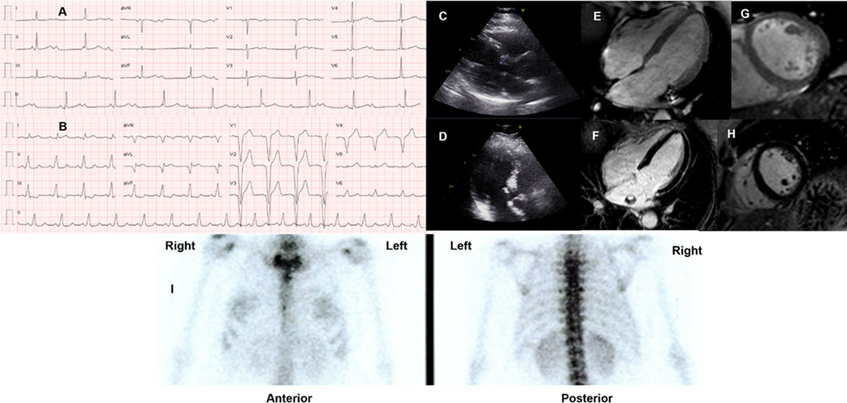 Complete atrial ventricle block of a patient with genetic ATTR amyloidosis