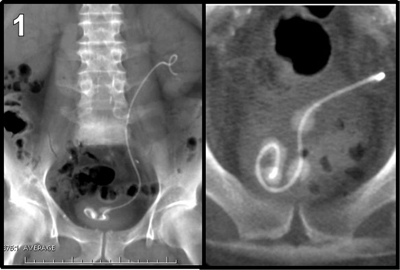 double j ureteral stent