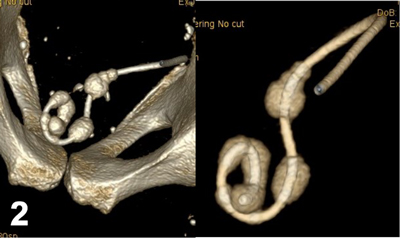 double j ureteral stent