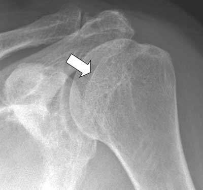 xray shoulder dislocation