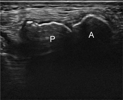 Double layered patella, Radiology Reference Article