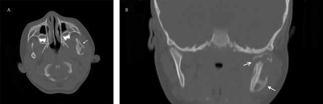 Clinical photograph showing the swelling in the mandibu