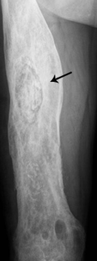 osteomyelitis x ray jaw