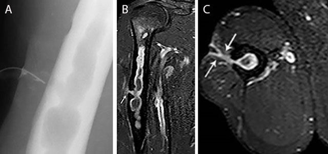 osteomyelitis x ray jaw