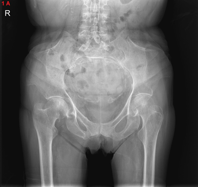 Nail Patella Syndrome Awareness - Clubfoot, otherwise known as talipes, is  an abnormal bone formation resulting in twisted feet. It occurs in around  20% of NPS patients and may affect both feet.