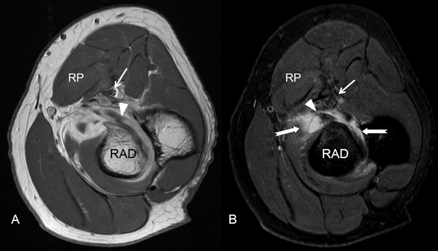 The Median Nerve at the Carpal Tunnel … and Elsewhere - Journal of the  Belgian Society of Radiology