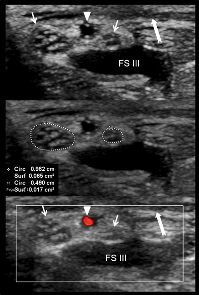 The Median Nerve at the Carpal Tunnel … and Elsewhere - Journal of