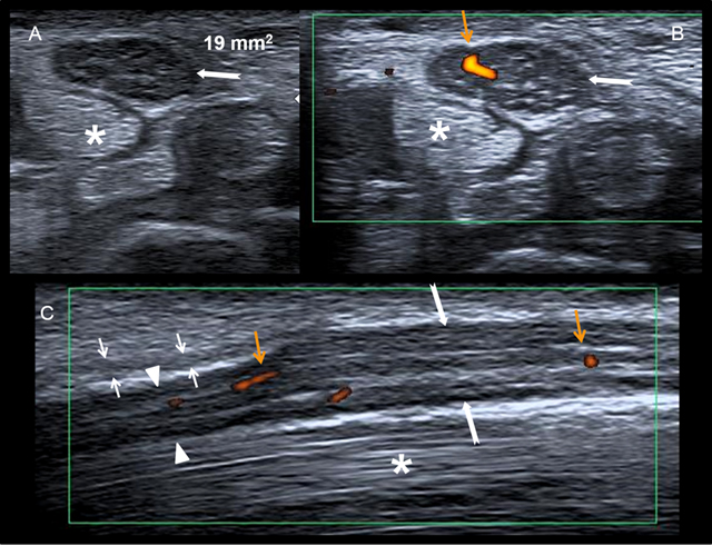 Standard anatomy of the median nerve