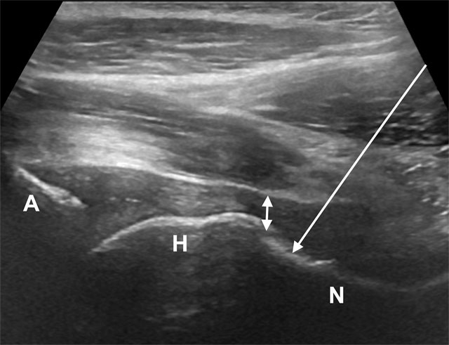 intra articular hip injection technique