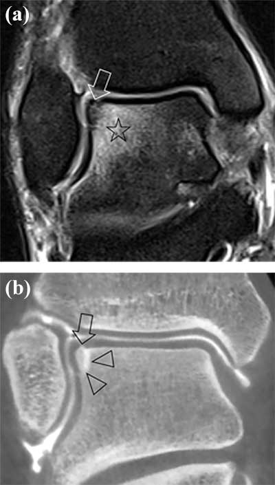 talus fracture mri