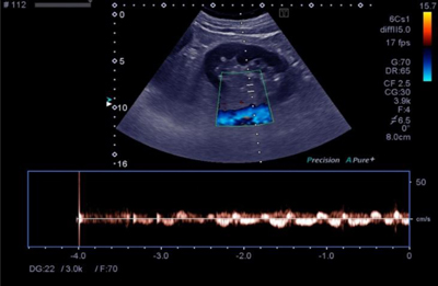 renal artery anatomy ultrasound