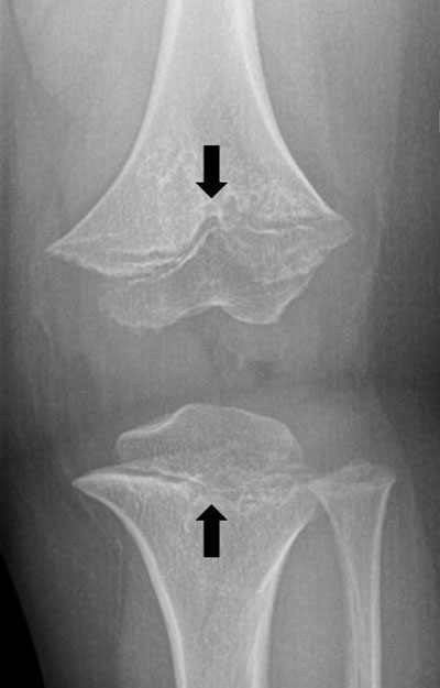 achondroplasia x ray vs normal