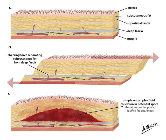 Imaging Features of Morel Lavall e Lesions Journal of the