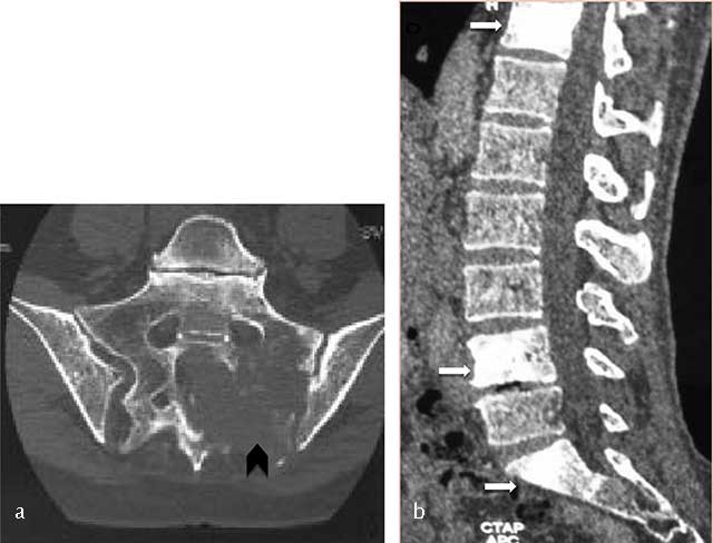 健康・医学 Cancer in the spine Spinal Cancer: What You Should Know