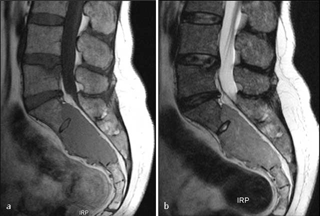 Imaging of Malignant Primitive Tumors of the Spine | Journal
