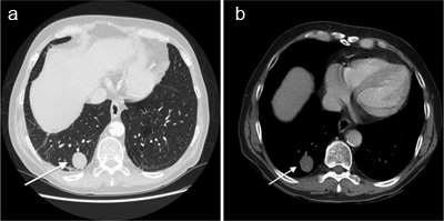 lobe pulmonary nodule