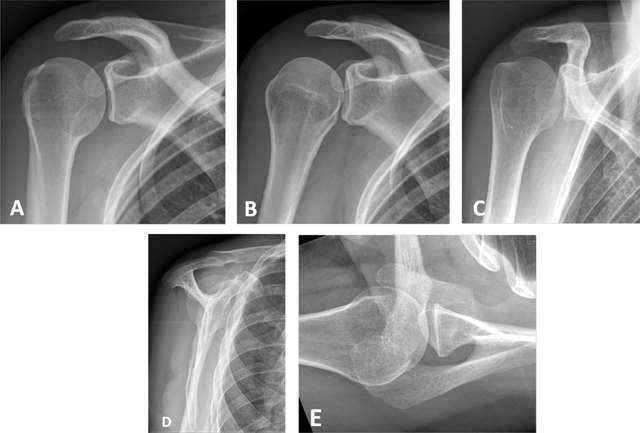 shoulder joint anatomy mri