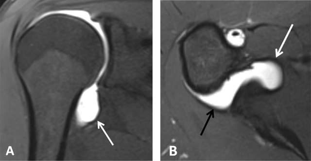 Typical magnetic resonance imaging scan showing the coracohumeral